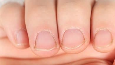 u&ntilde;as feas quebradizas