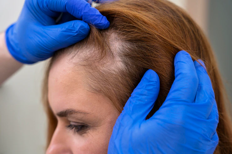 Mujer recibiendo un tratamiento de pérdida de cabello en una clínica estrés salud capilar