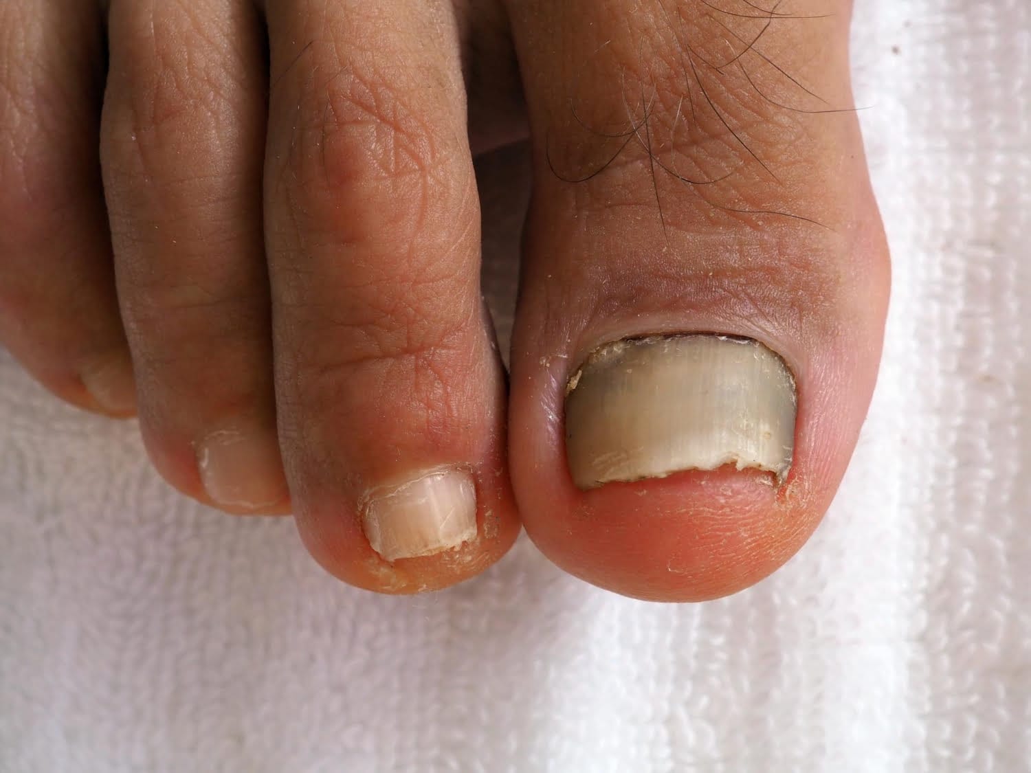 Onicomicosis: 6 errores a evitar cuando se sufre de hongos en las uñas